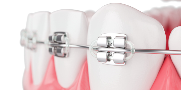 Principe de l'orthodontie
